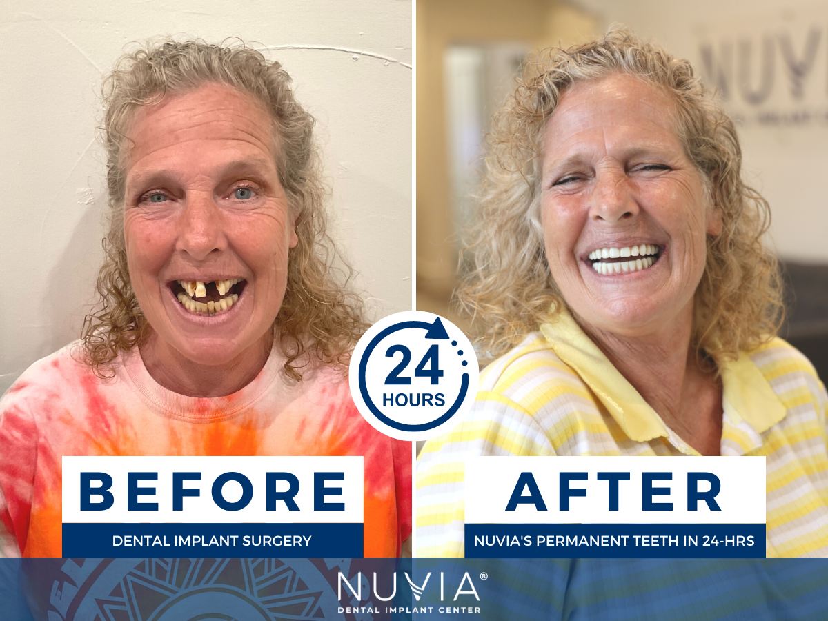 Dental Implants Before & After | Nuvia